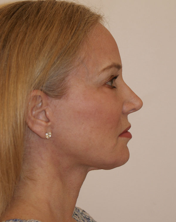 Photo of Patient 04 After Facial Fat Transfer Procedure