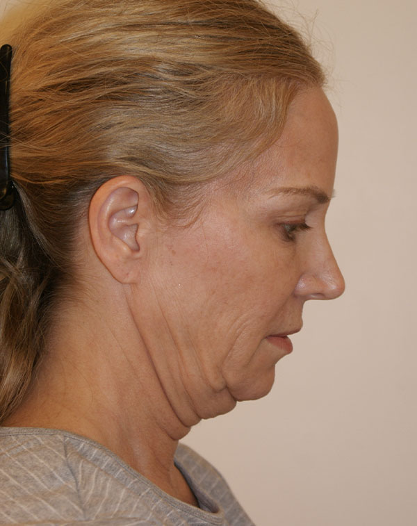 Photo of Patient 04 Before Facial Fat Transfer Procedure