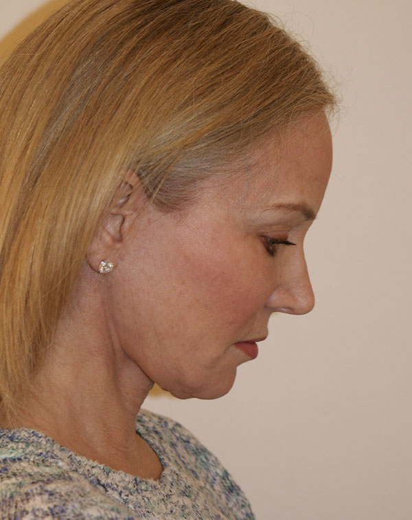 Photo of Patient 04 After Facial Fat Transfer Procedure