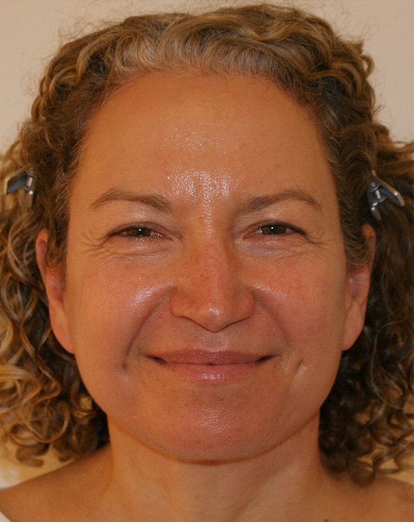 Photo of Patient 05 After Facial Fat Transfer Procedure