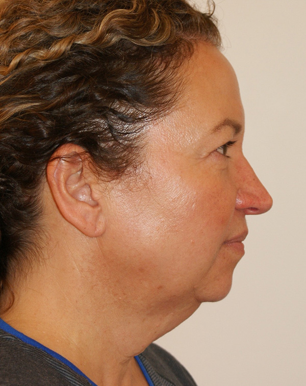 Photo of Patient 05 Before Facial Fat Transfer Procedure