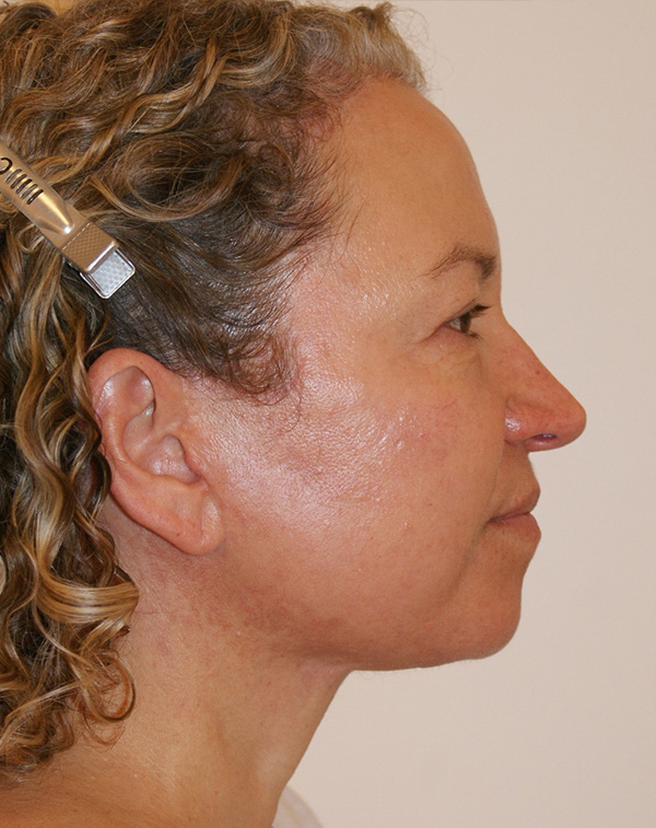 Photo of Patient 05 After Facial Fat Transfer Procedure