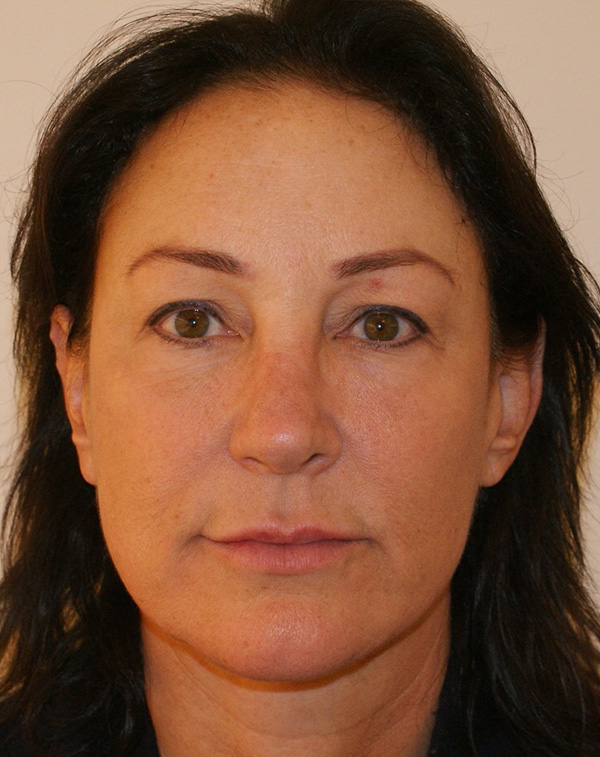 Photo of Patient 06 After Facial Fat Transfer Procedure