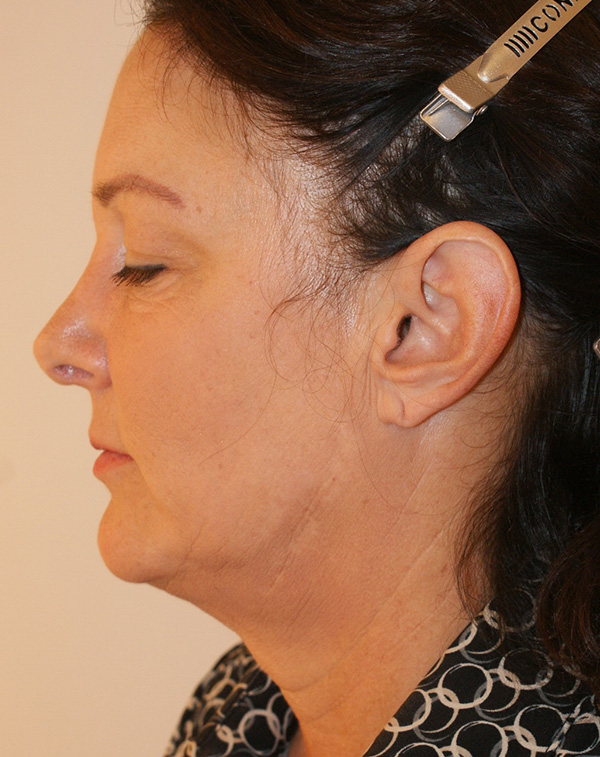 Photo of Patient 06 Before Facial Fat Transfer Procedure