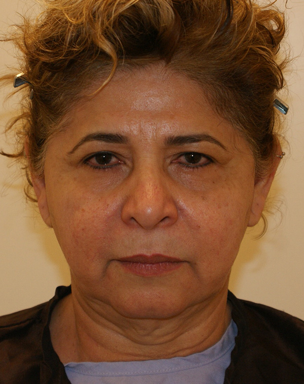 Photo of Patient 08 Before Facial Fat Transfer Procedure