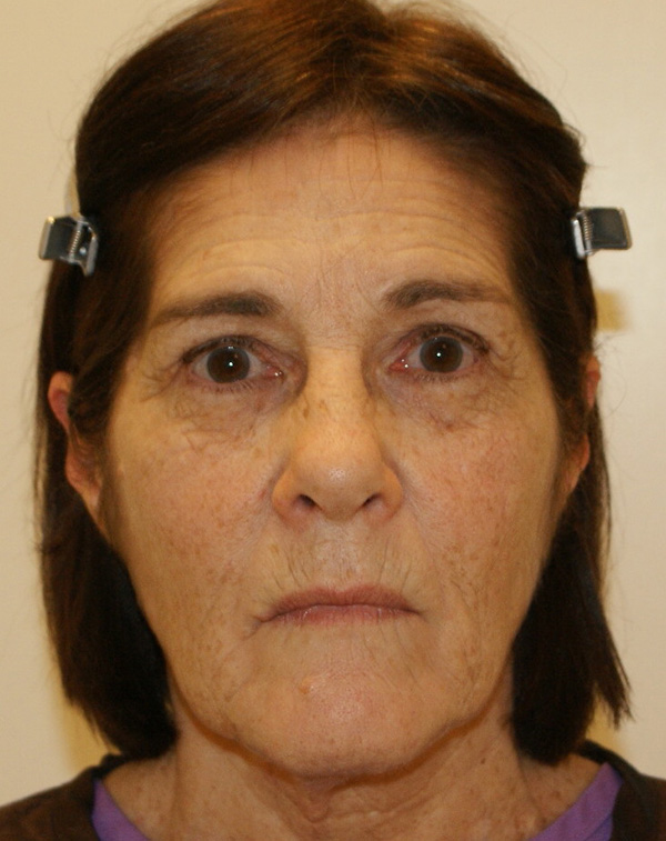 Photo of Patient 09 Before Facial Fat Transfer Procedure