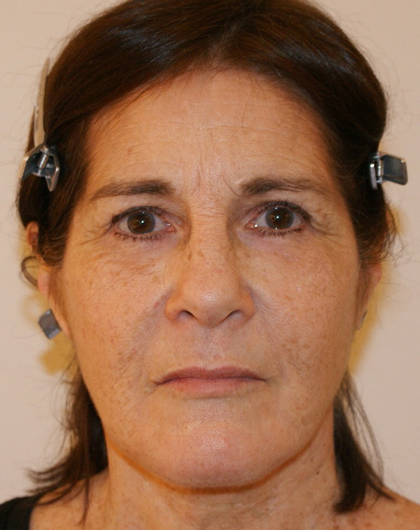 Photo of Patient 09 After Facial Fat Transfer Procedure