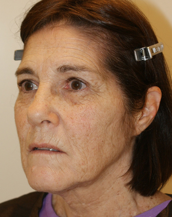 Photo of Patient 09 Before Facial Fat Transfer Procedure