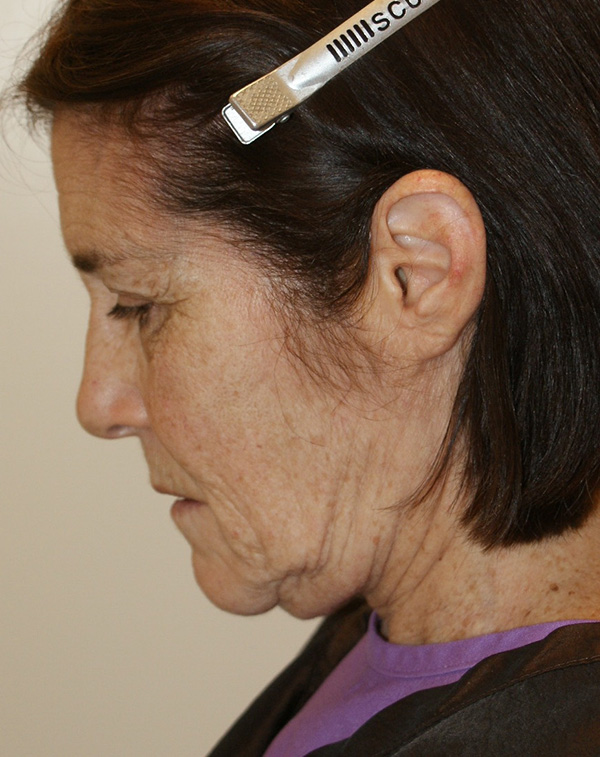 Photo of Patient 09 Before Facial Fat Transfer Procedure