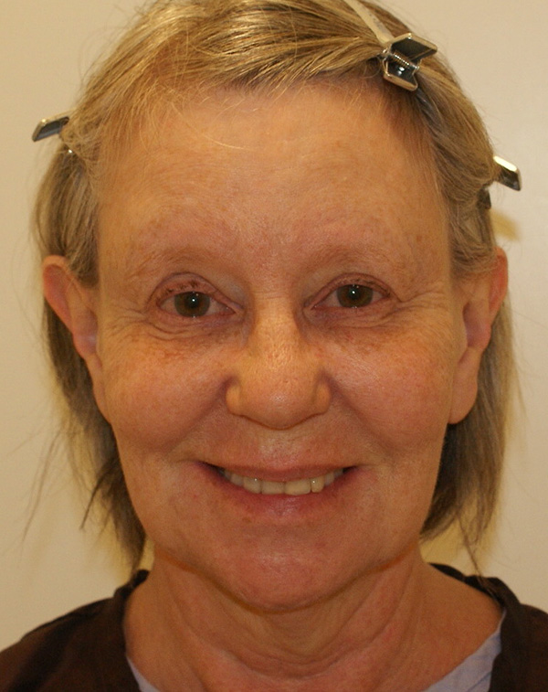 Photo of Patient 10 Before Facial Fat Transfer Procedure
