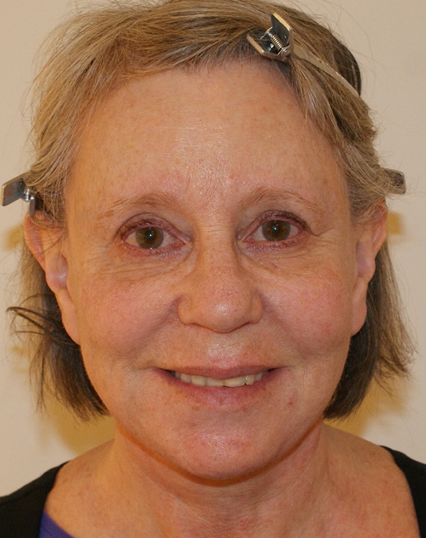 Photo of Patient 10 After Facial Fat Transfer Procedure