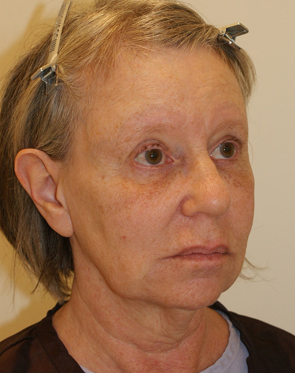 Photo of Patient 10 Before Facial Fat Transfer Procedure