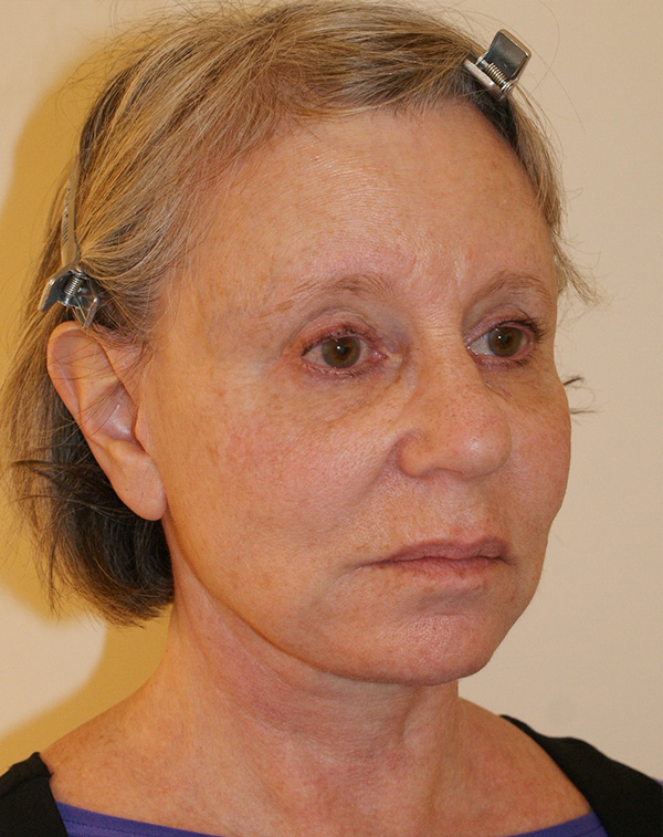 Photo of Patient 10 After Facial Fat Transfer Procedure