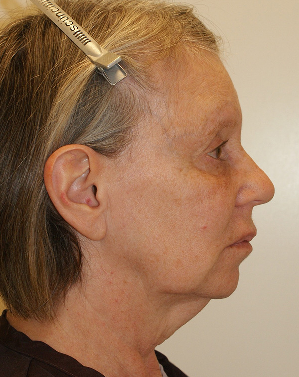 Photo of Patient 10 Before Facial Fat Transfer Procedure