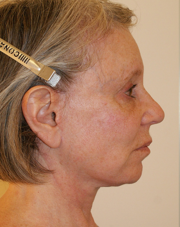 Photo of Patient 10 After Facial Fat Transfer Procedure