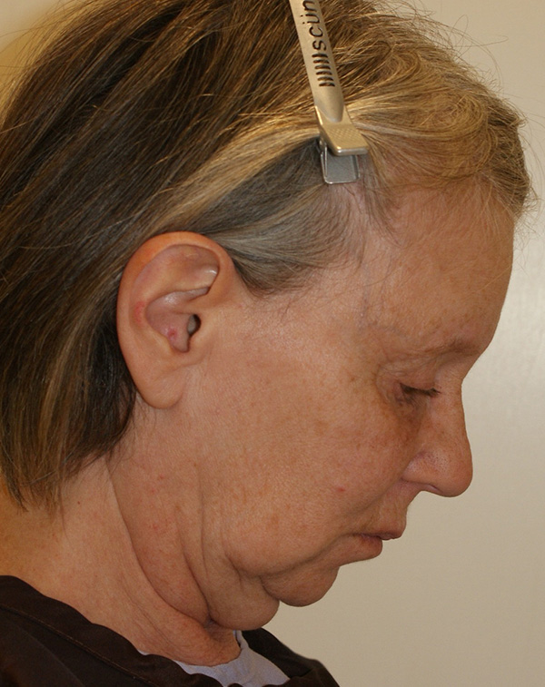 Photo of Patient 10 Before Facial Fat Transfer Procedure