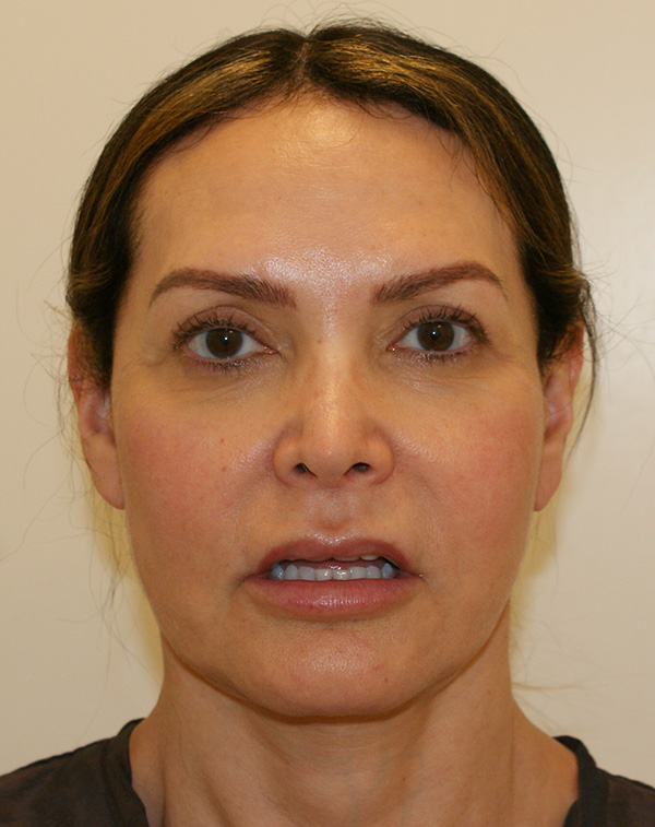 Lip Lift Before and After | Dino Elyassnia, MD