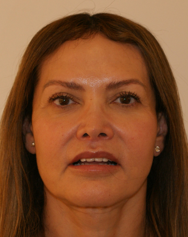 Lip Lift Before and After | Dino Elyassnia, MD