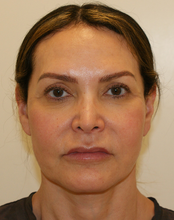 Photo of Patient 01 Before Lip Lift Procedure