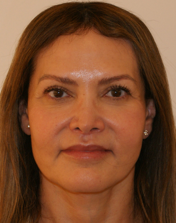 Photo of Patient 01 After Lip Lift Procedure