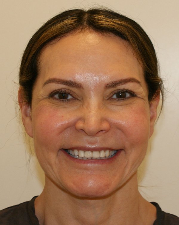 Photo of Patient 01 Before Lip Lift Procedure