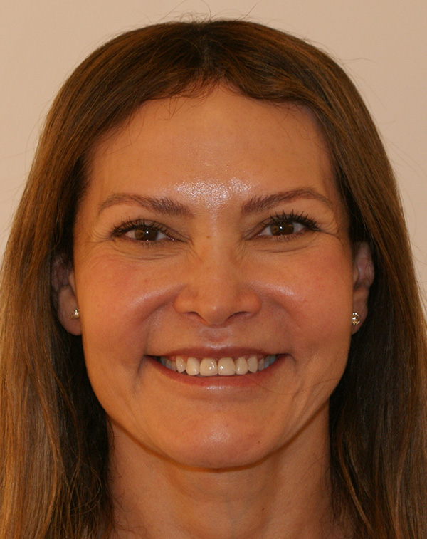 Photo of Patient 01 After Lip Lift Procedure