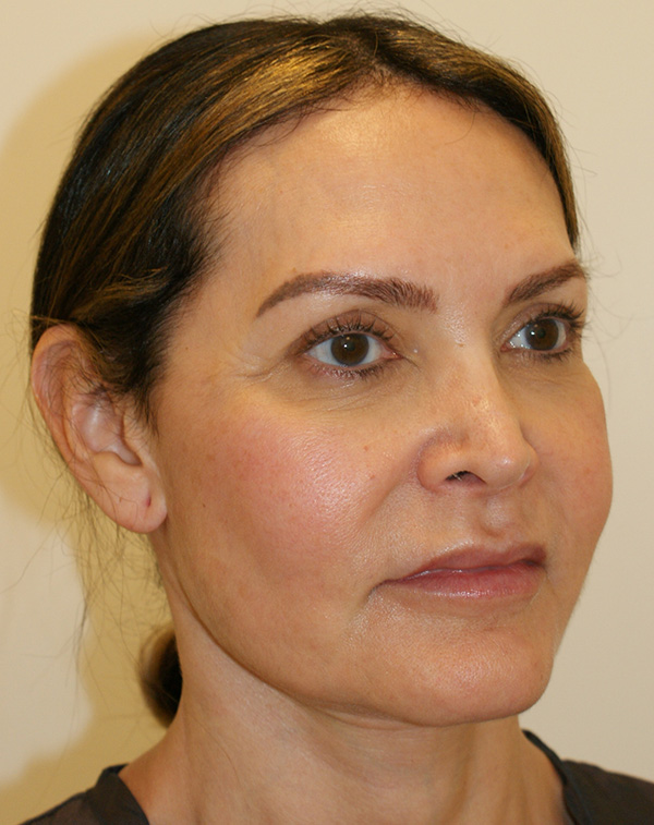 Photo of Patient 01 Before Lip Lift Procedure