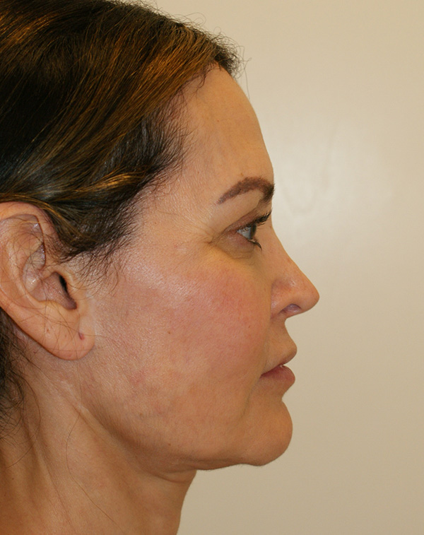 Photo of Patient 01 Before Lip Lift Procedure