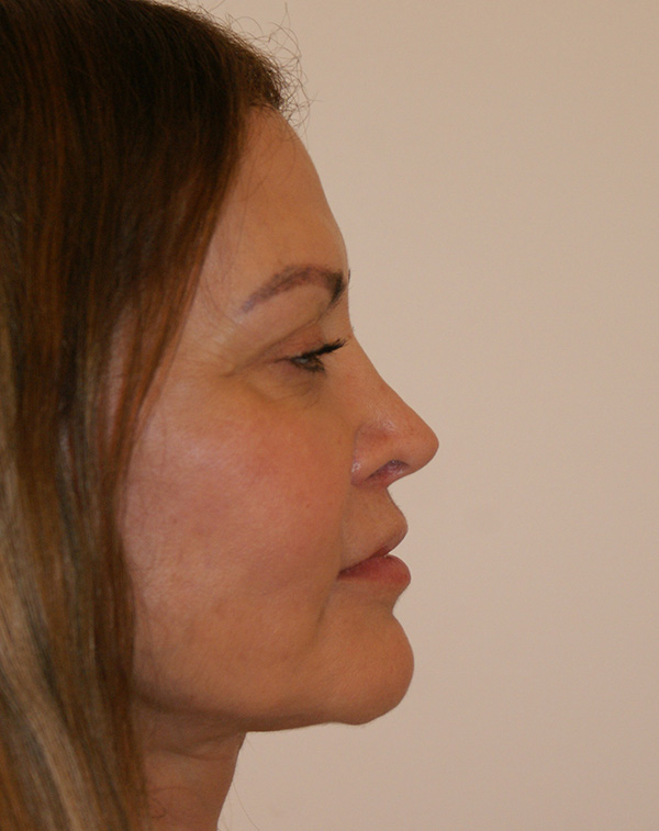 Photo of Patient 01 After Lip Lift Procedure