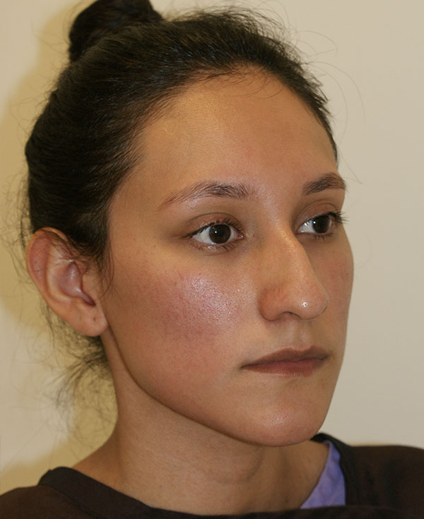 Photo of Patient 01 Before Nose Procedure