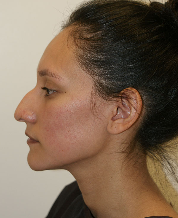 Photo of Patient 01 Before Nose Procedure