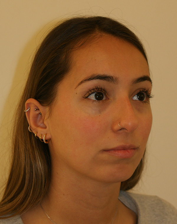 Photo of Patient 01 Before Nose Procedure