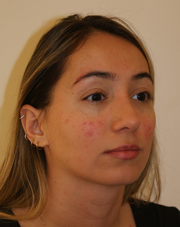 Photo of Patient 01 After Nose Procedure