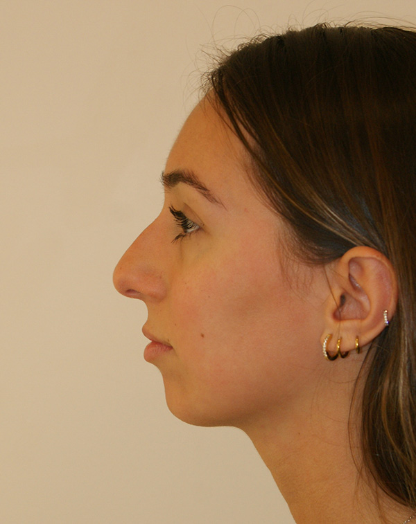 Photo of Patient 01 Before Nose Procedure