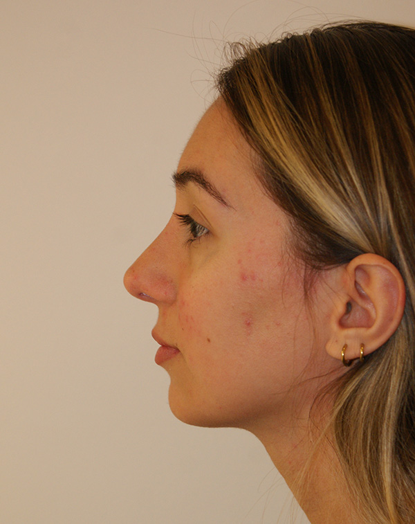 Photo of Patient 01 After Nose Procedure