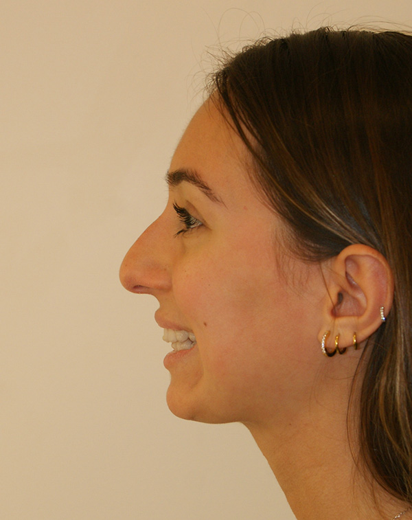 Photo of Patient 01 Before Nose Procedure