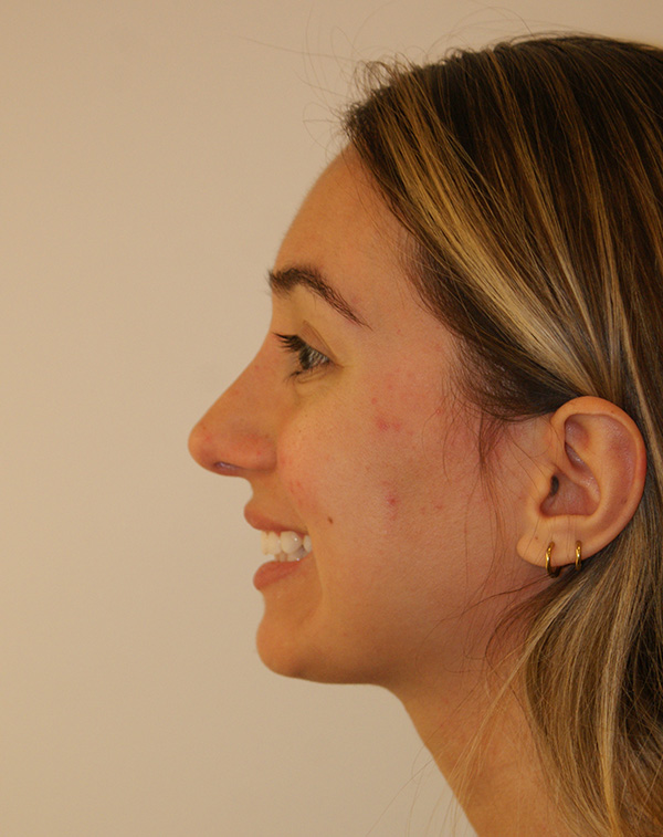 Photo of Patient 01 After Nose Procedure