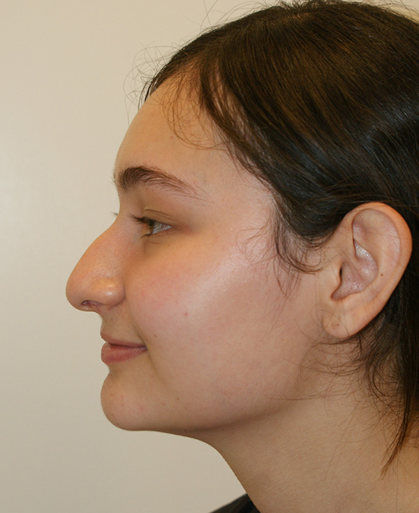 Photo of Patient 02 Before Nose Procedure