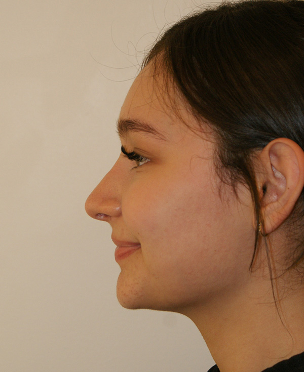 Photo of Patient 02 After Nose Procedure