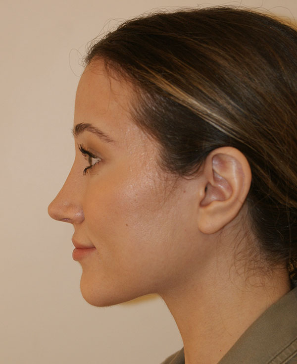 Photo of Patient 03 After Nose Procedure