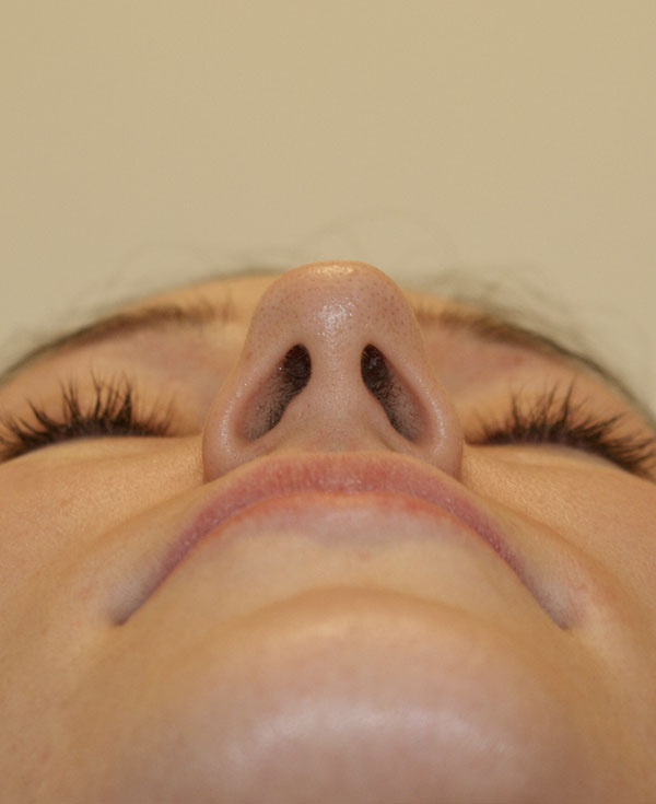 Photo of Patient 03 Before Nose Procedure