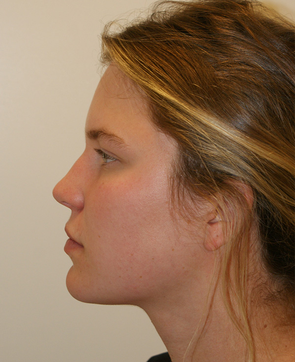 Photo of Patient 03 Before Nose Procedure