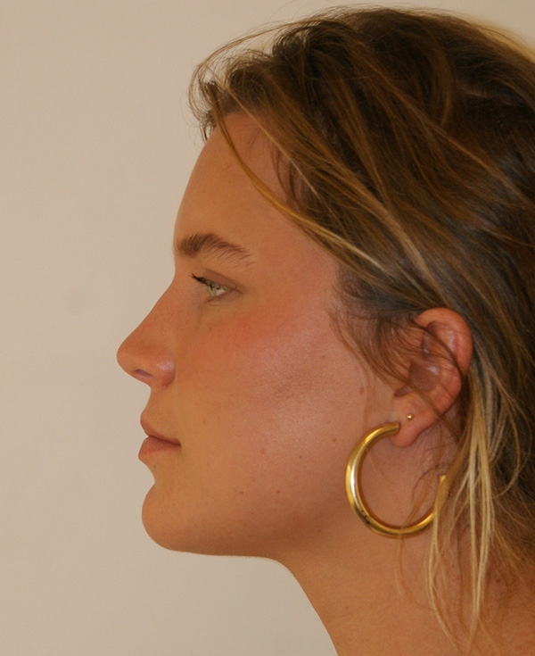 Photo of Patient 03 After Nose Procedure