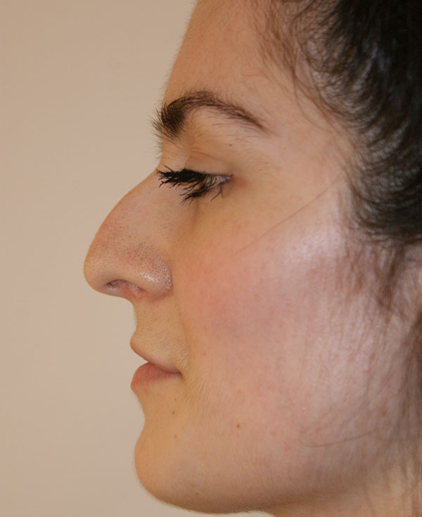 Photo of Patient 04 Before Nose Procedure