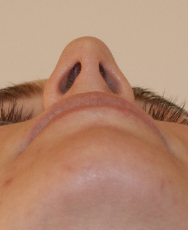 Photo of Patient 05 Before Nose Procedure