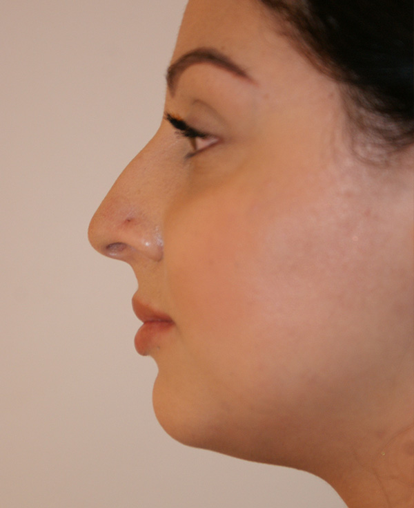 Photo of Patient 05 Before Nose Procedure