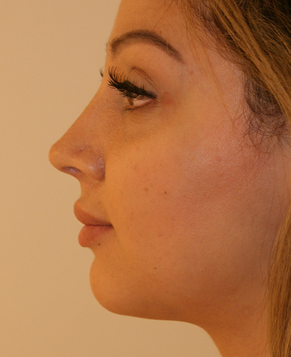 Photo of Patient 05 After Nose Procedure