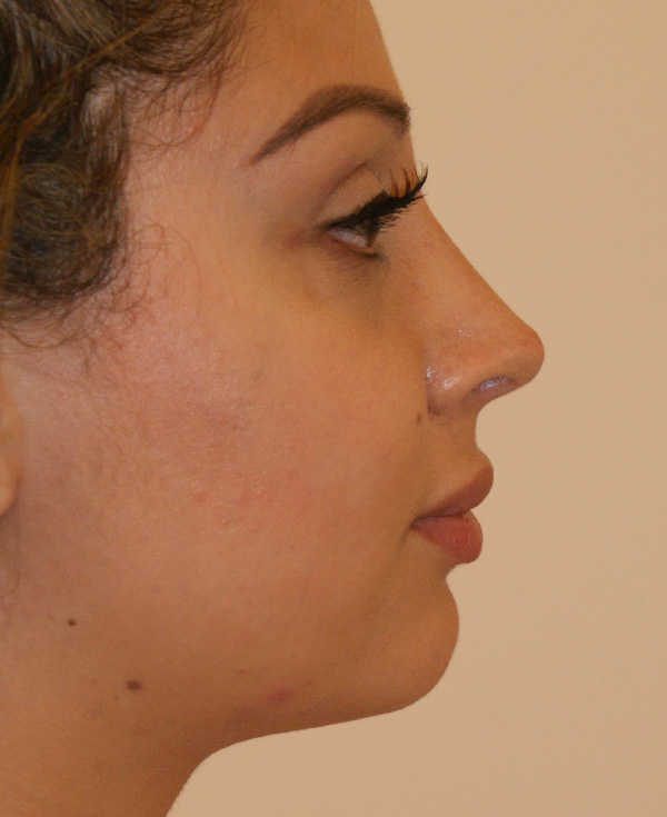 Photo of Patient 05 After Nose Procedure