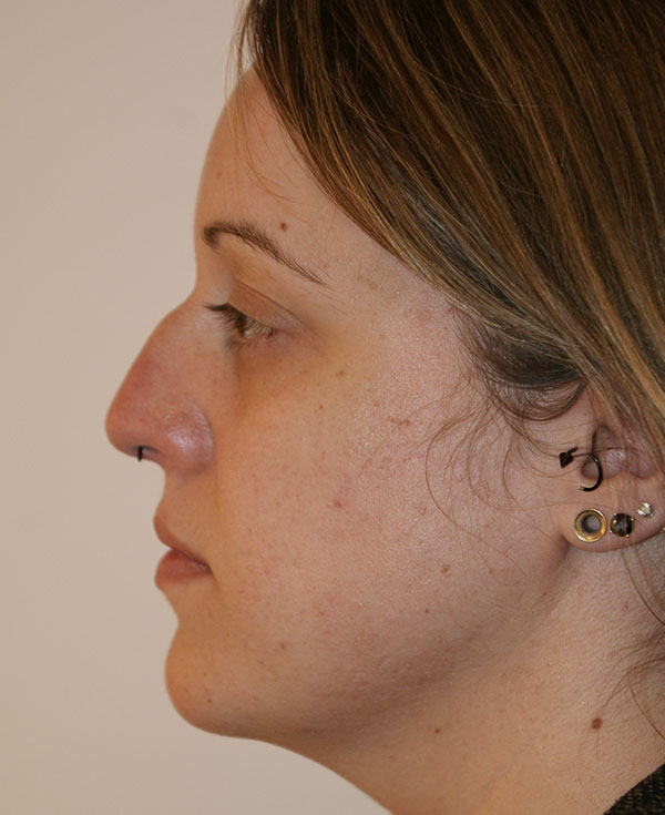 Photo of Patient 06 Before Nose Procedure