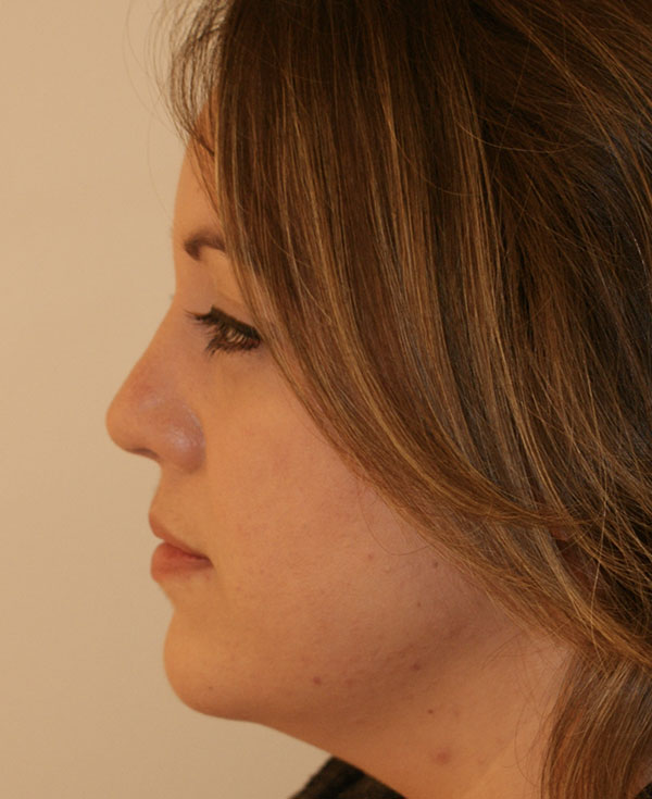 Photo of Patient 06 After Nose Procedure